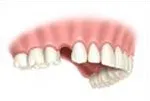 Single Tooth
