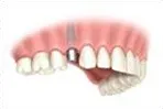 A tooth to be implanted