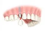 A tooth to be implanted