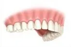 Complete denture