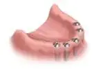 Image of a mouth without teeth