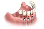 The patient's multiple dental implants