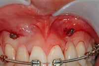 Orthodontic-Anchorage-Device