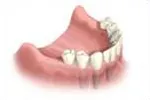 The patient's multiple dental implants