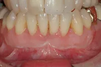 Post-Gingival-Graft