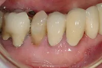 Post-Gingival-Graft2