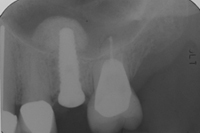 Post-Inferior-With-Implant