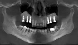 Post-Lateral-With-Implants