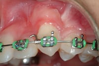 Post-Orthodontic-Anchorage