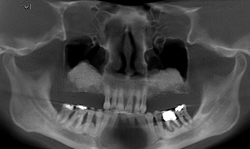 Post-lateral
