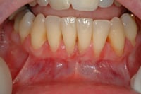 Pre-Gingival-Graft