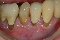 Pre-Gingival-Graft2