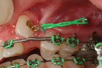 Pre-Orthodontic-Anchorage