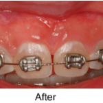 Frenectomy after