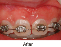 Frenectomy after