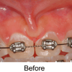 Frenectomy before