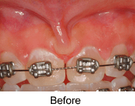 Frenectomy before