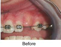 Exposure of Unerupted Teeth up close before 