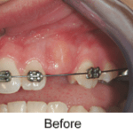 Exposure of Unerupted Teeth up close before 