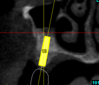 cross-section-implant