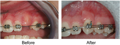 Exposure of Unerupted Teeth before and after