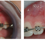 Exposure of Unerupted Teeth before and after