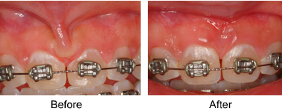 Frenectomy before and after 