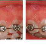Frenectomy before and after 