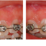 Frenectomy before and after 