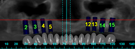 maxillary-implants