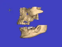 simplant-maxillary-and-mandibular