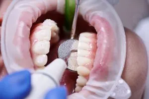 Dental operation