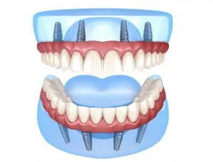 Illustration: All-On-4 Dental Implants
