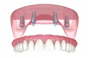 Illustration: All-On-4 Dental Implants