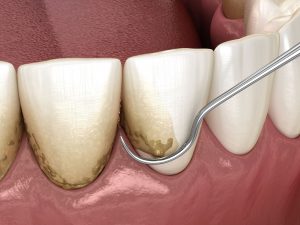 Up-close photo of periodontal care virginia beach
